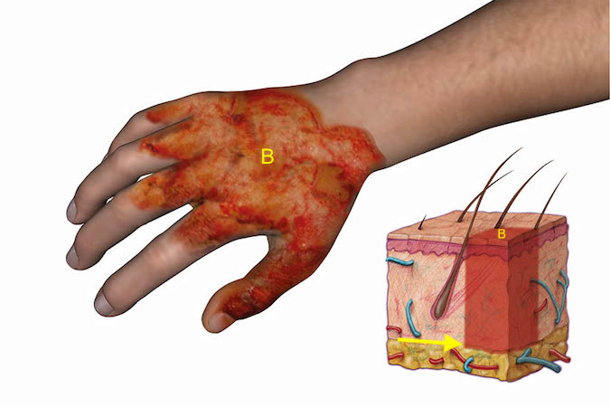 Burns Hand Surgery Resource 4370